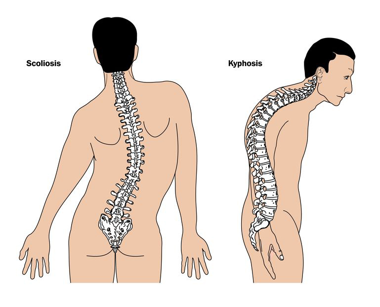 scoliosis vs kyphosis